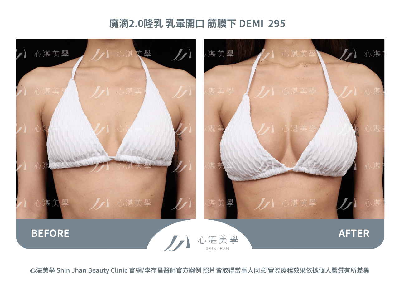 盈波隆乳 胸下緣開口 筋膜下 SHR 300CC 術前術後分享