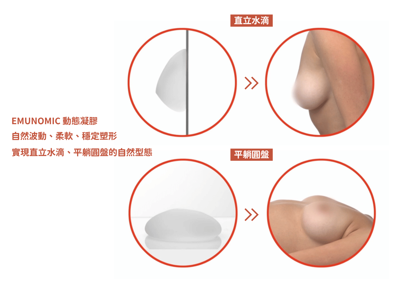 珍珠波隆乳站立時呈水滴形態，平躺後自然轉為圓盤——動態模擬真實乳房因重力產生的形態變化