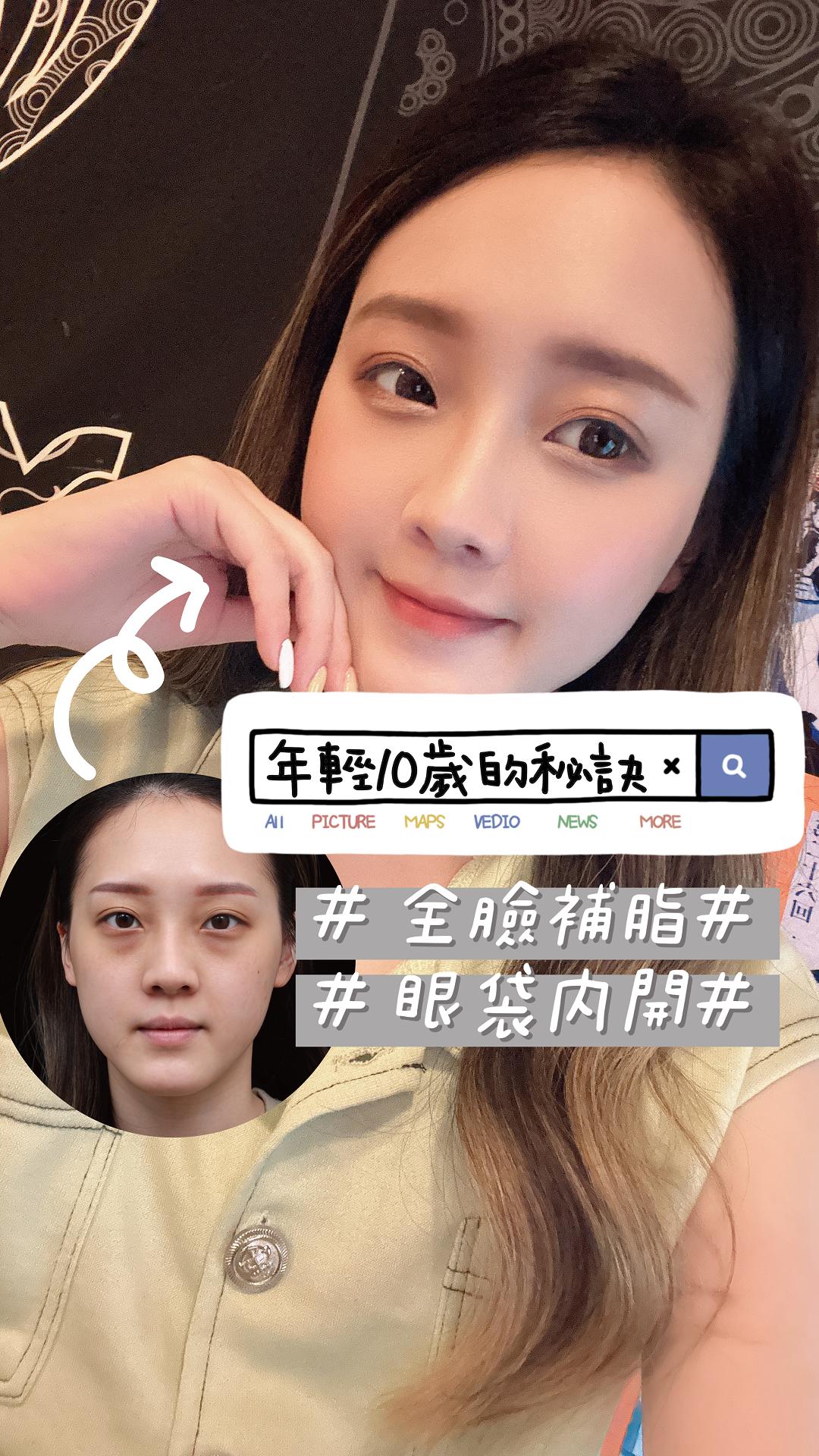 『年輕10歲的秘訣』#全臉補脂 x #眼袋內開！美麗蛻變全紀錄｜台北中山區醫美整形權威-心湛美學診所    Feat.李存昌院長