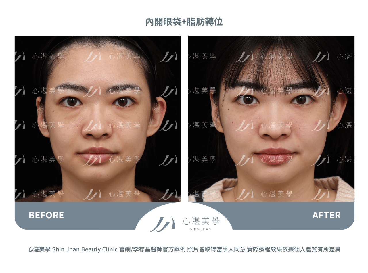 眼袋內開脂肪轉位術前術後對比：淚溝凹陷改善實際效果