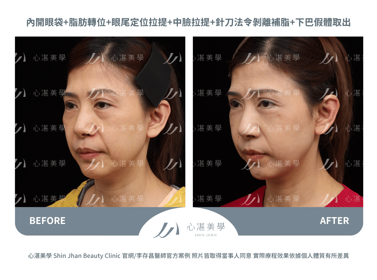 眼袋內開脂肪轉位+內開式中臉拉提術前術後對比：淚溝凹陷改善實際效果