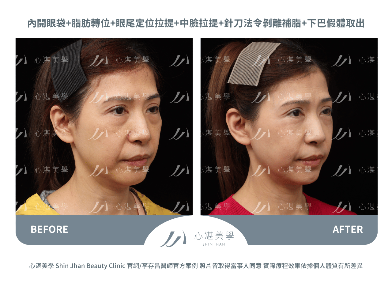眼袋內開脂肪轉位+內開式中臉拉提術前術後對比：淚溝凹陷改善實際效果