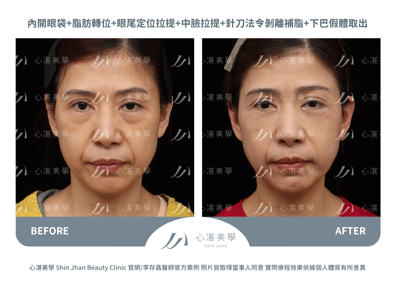 眼袋內開脂肪轉位+內開式中臉拉提術前術後對比：淚溝凹陷改善實際效果