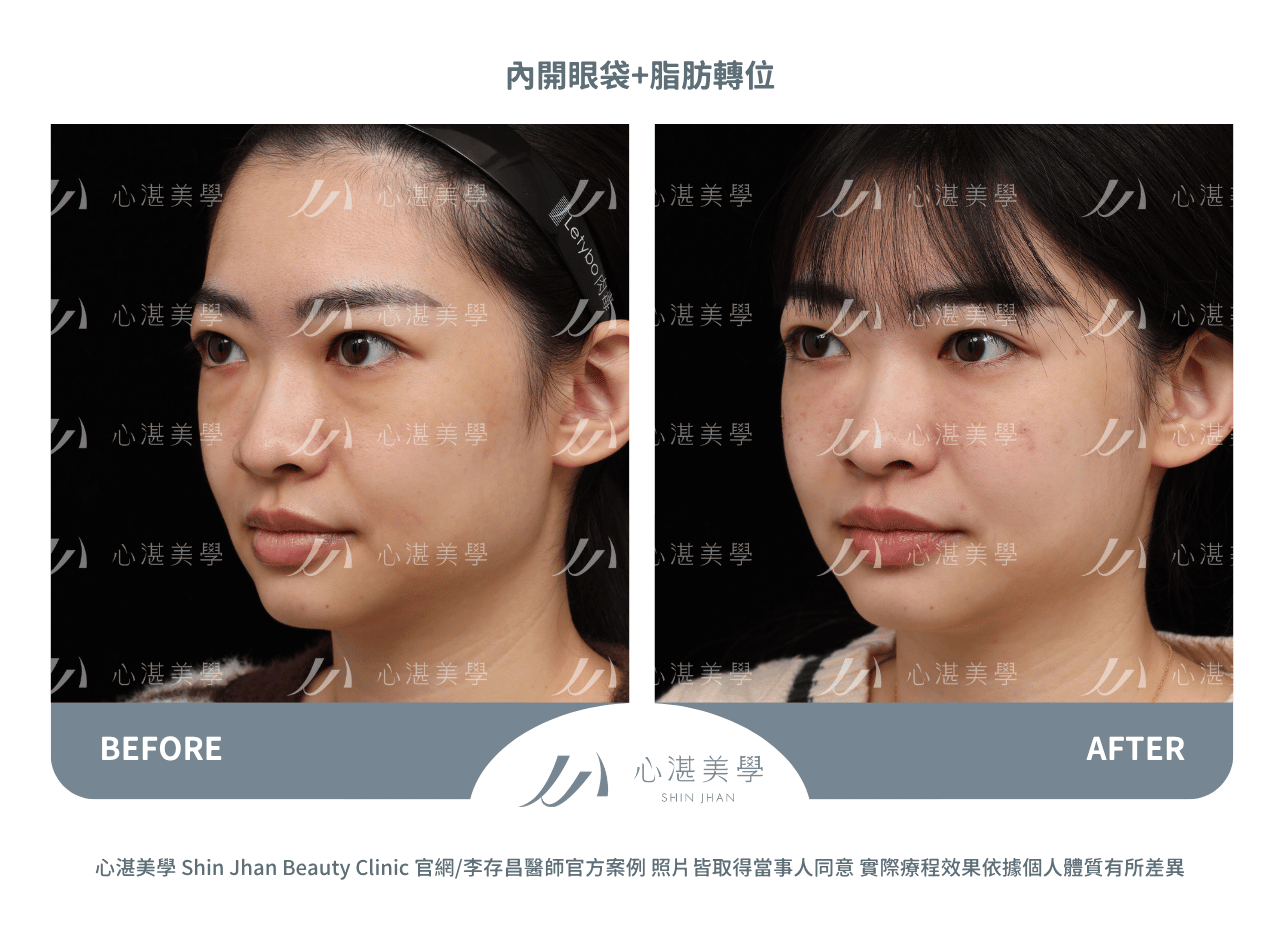 眼袋內開脂肪轉位術前術後對比：淚溝凹陷改善實際效果