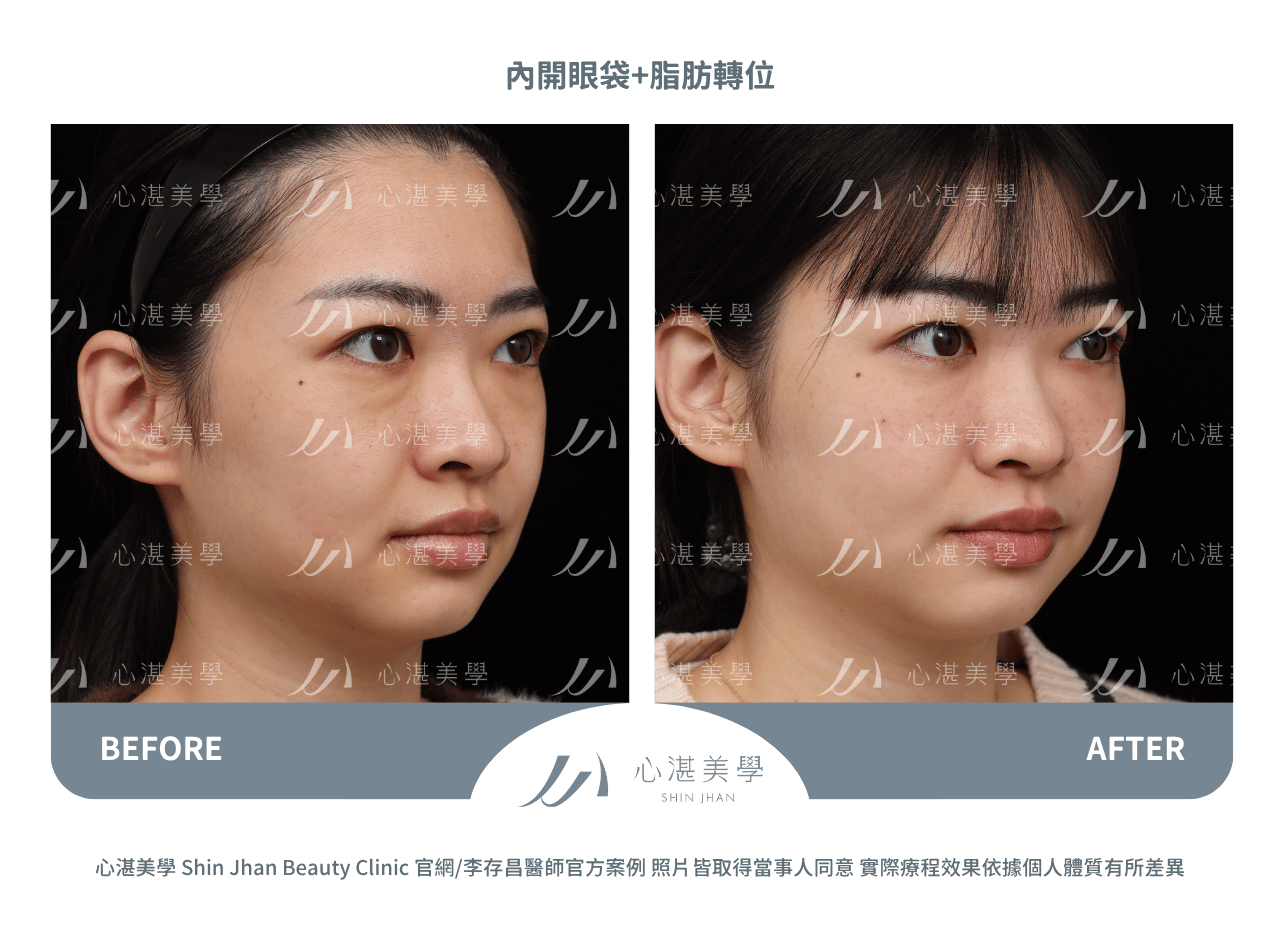 眼袋內開脂肪轉位術前術後對比：淚溝凹陷改善實際效果