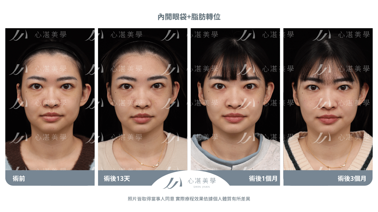 blepharoplasty-internal-external-fixation-before+after-90days (1)