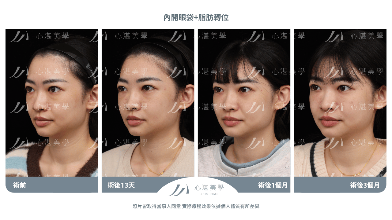 眼袋內開脂肪轉位術後恢復時間軸：Day 1至90完整恢復期指南