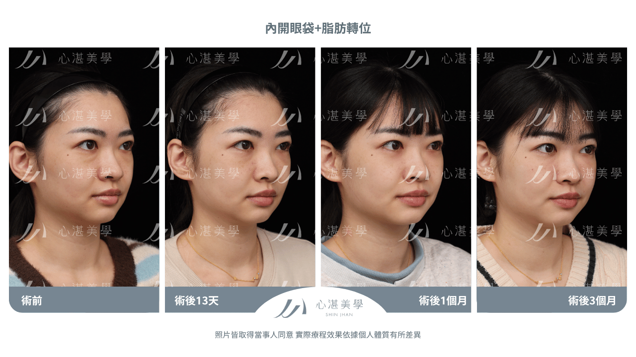 眼袋內開脂肪轉位術後恢復時間軸：Day 1至90完整恢復期指南