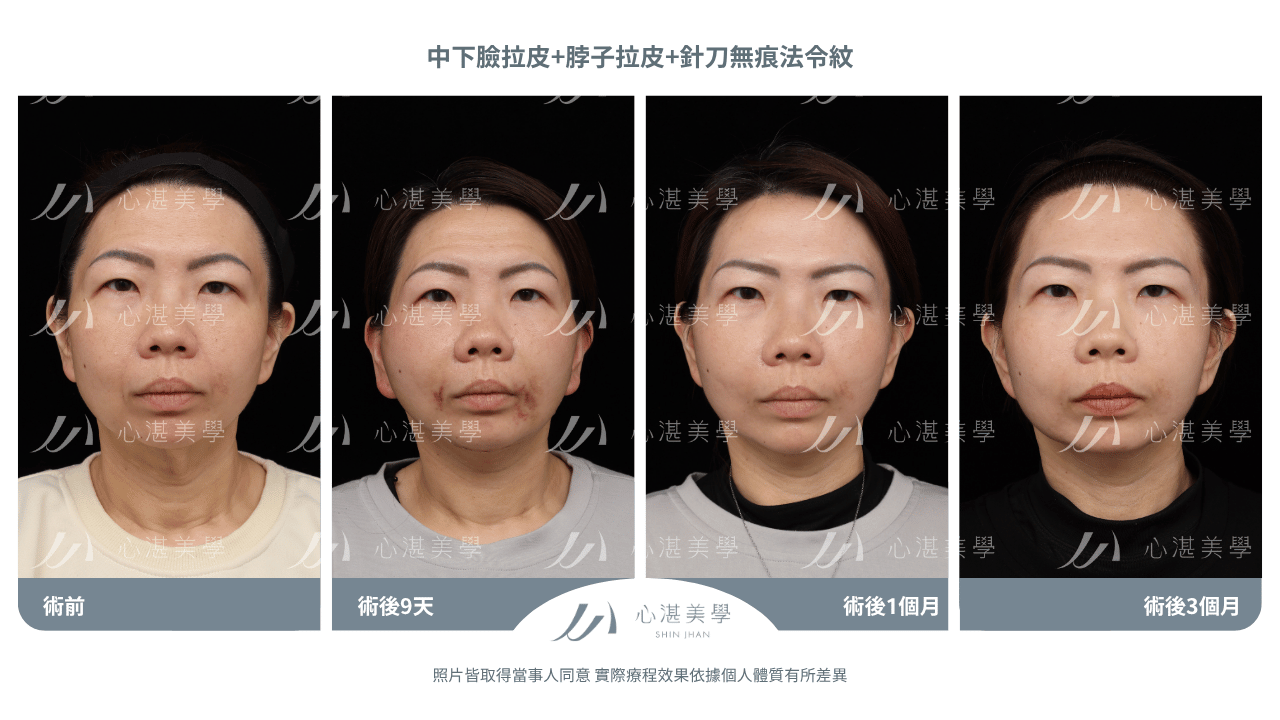 「中下臉拉皮手術術後案例｜46歲法令紋脖子中下臉鬆弛改善前後對比」