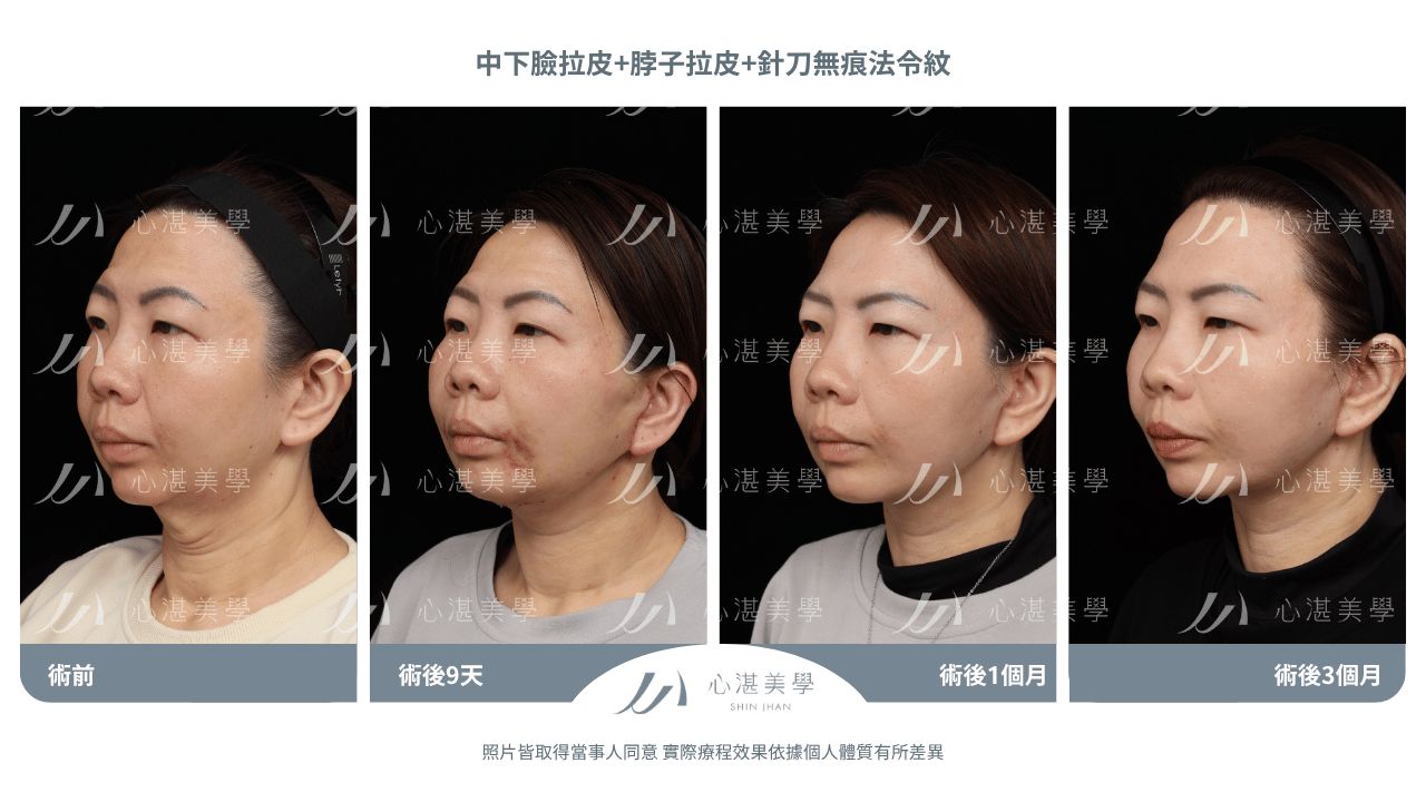「中下臉拉皮手術術後案例｜46歲法令紋脖子中下臉鬆弛改善前後對比」