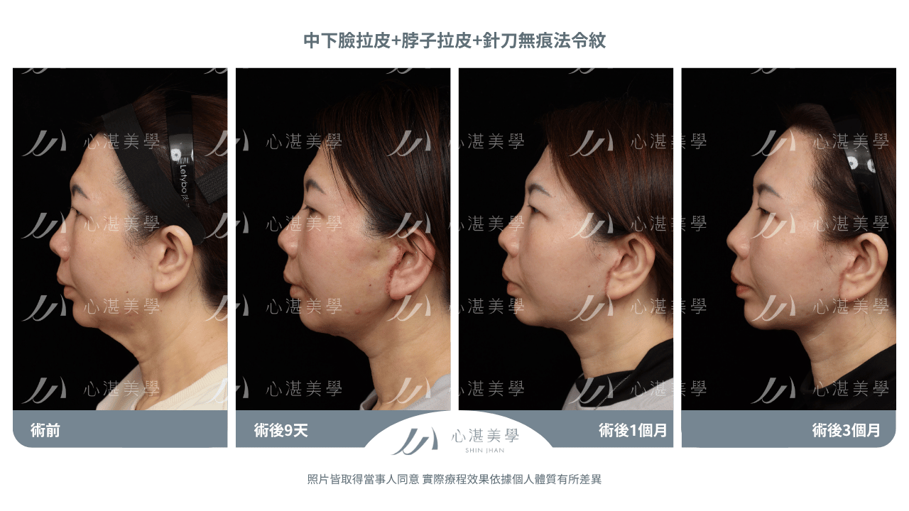 「中下臉拉皮手術術後案例｜46歲法令紋脖子中下臉鬆弛改善前後對比」