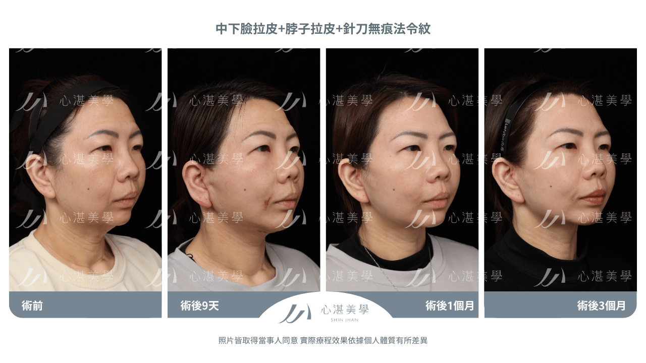 「中下臉拉皮手術術後案例｜46歲法令紋脖子中下臉鬆弛改善前後對比」