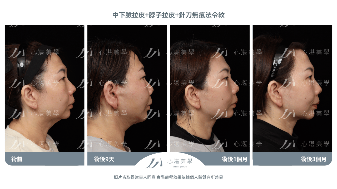 「中下臉拉皮手術術後案例｜46歲法令紋脖子中下臉鬆弛改善前後對比」