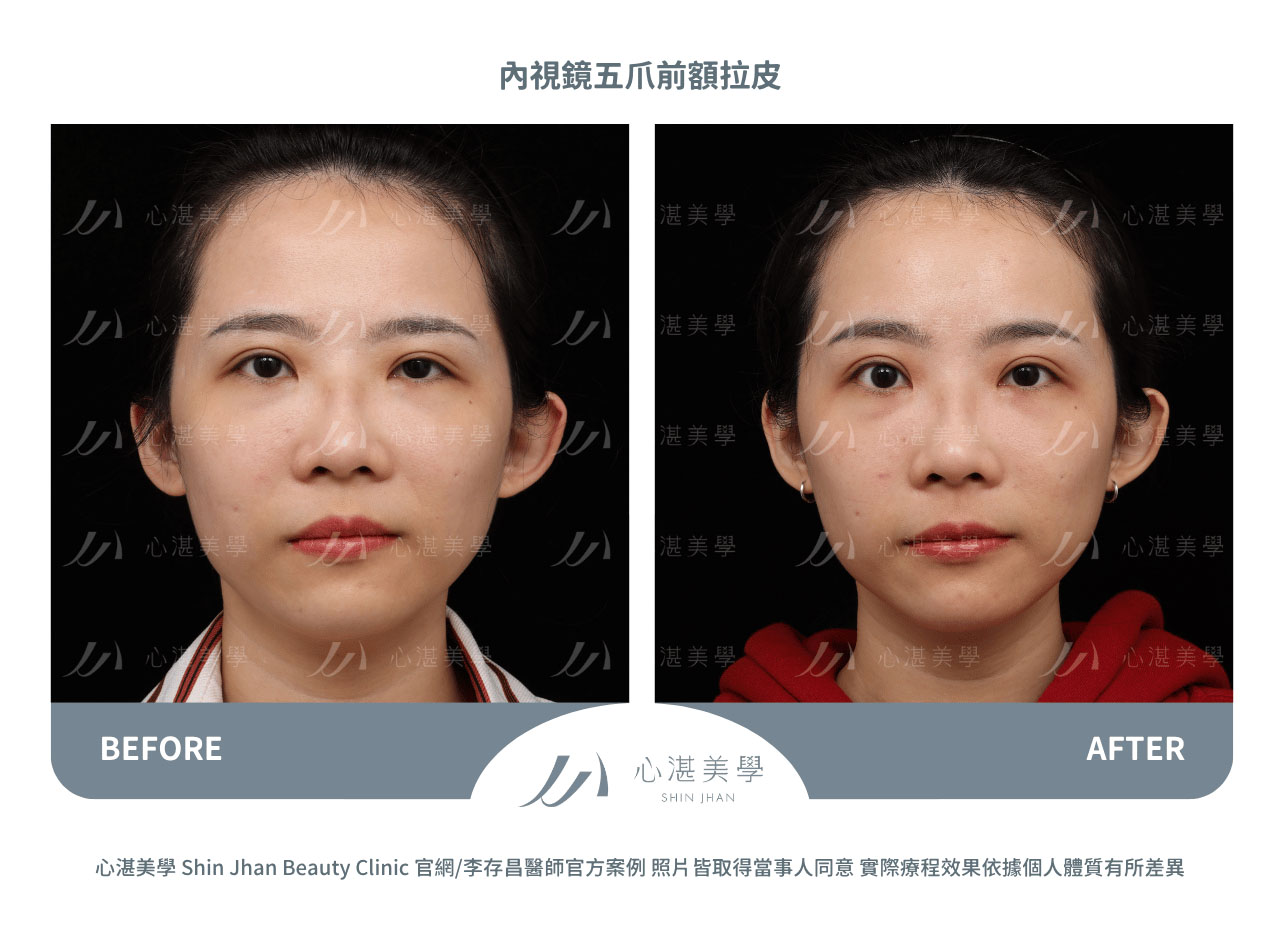 內視鏡前額拉皮術前術後案例分享