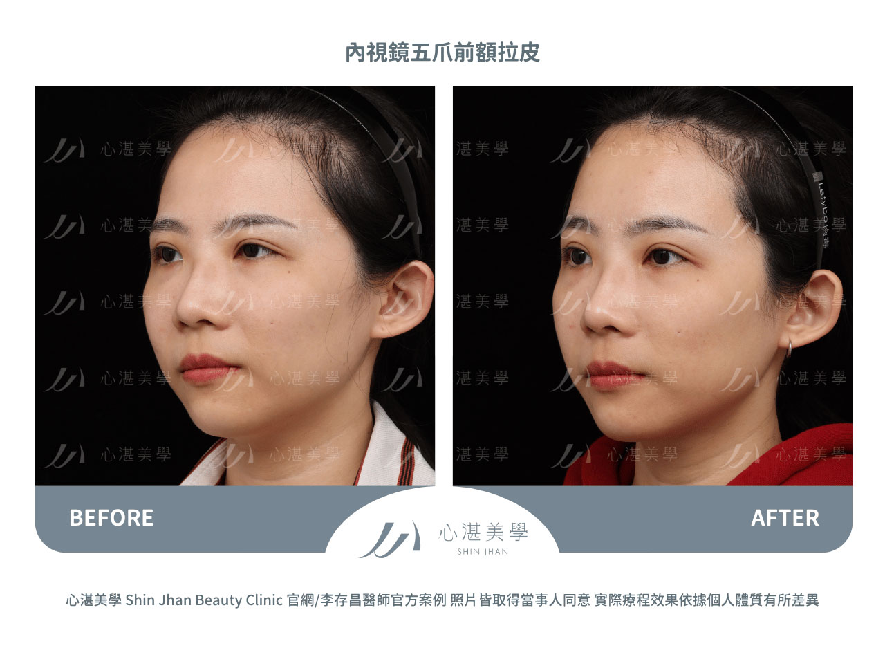 內視鏡前額拉皮術前術後案例分享