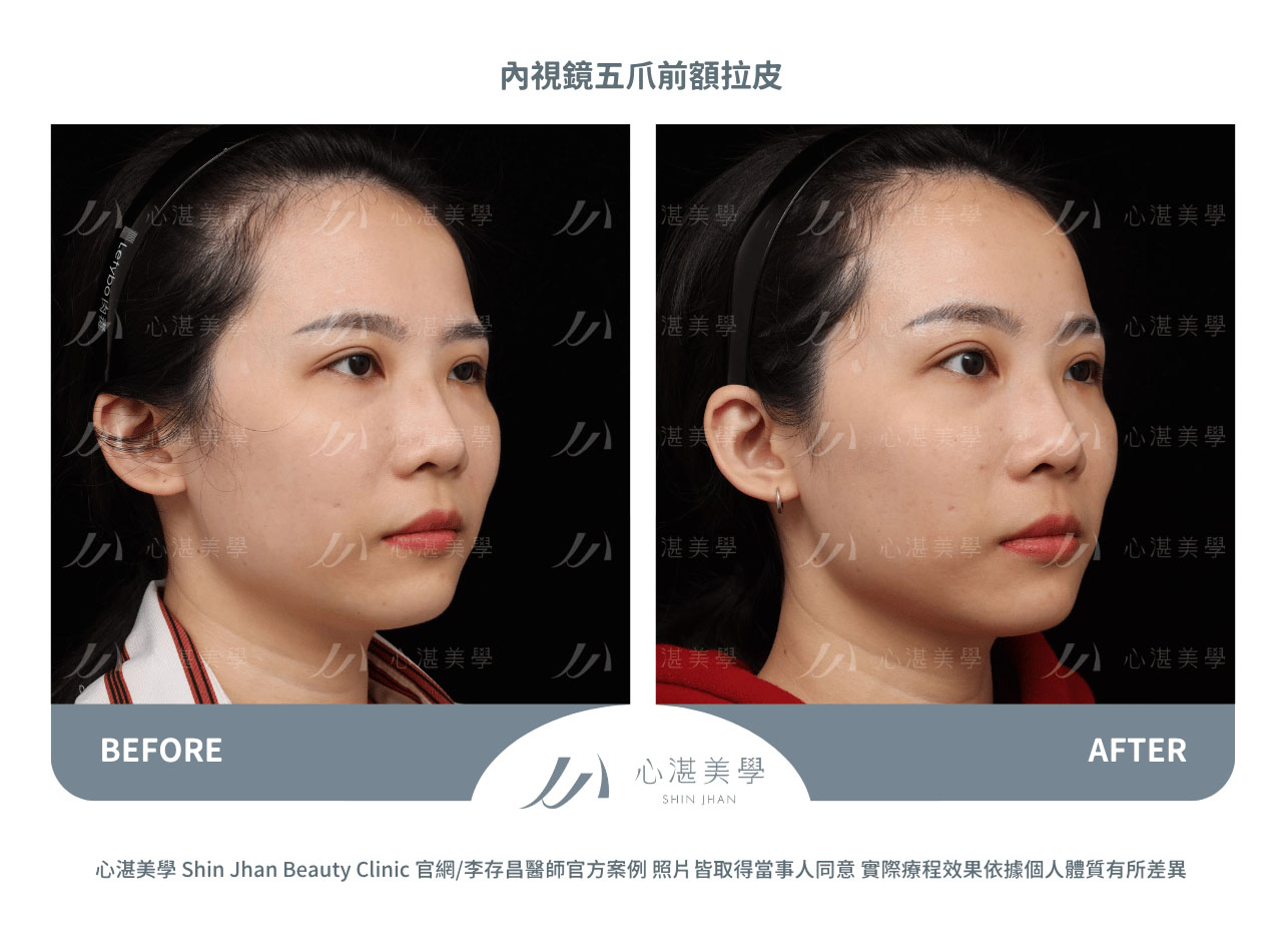 內視鏡前額拉皮術前術後案例分享