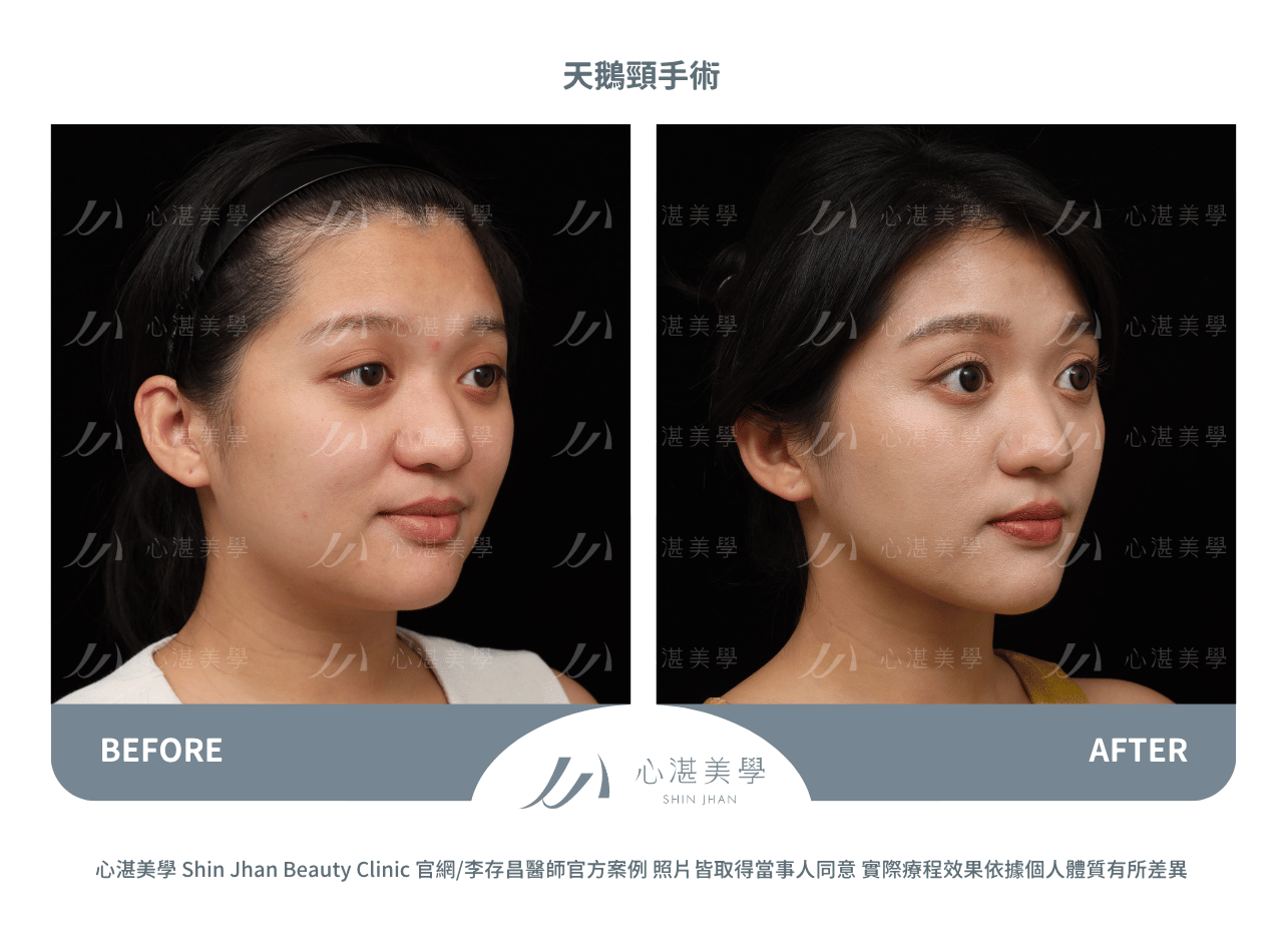 天鵝頸手術案例術前術後