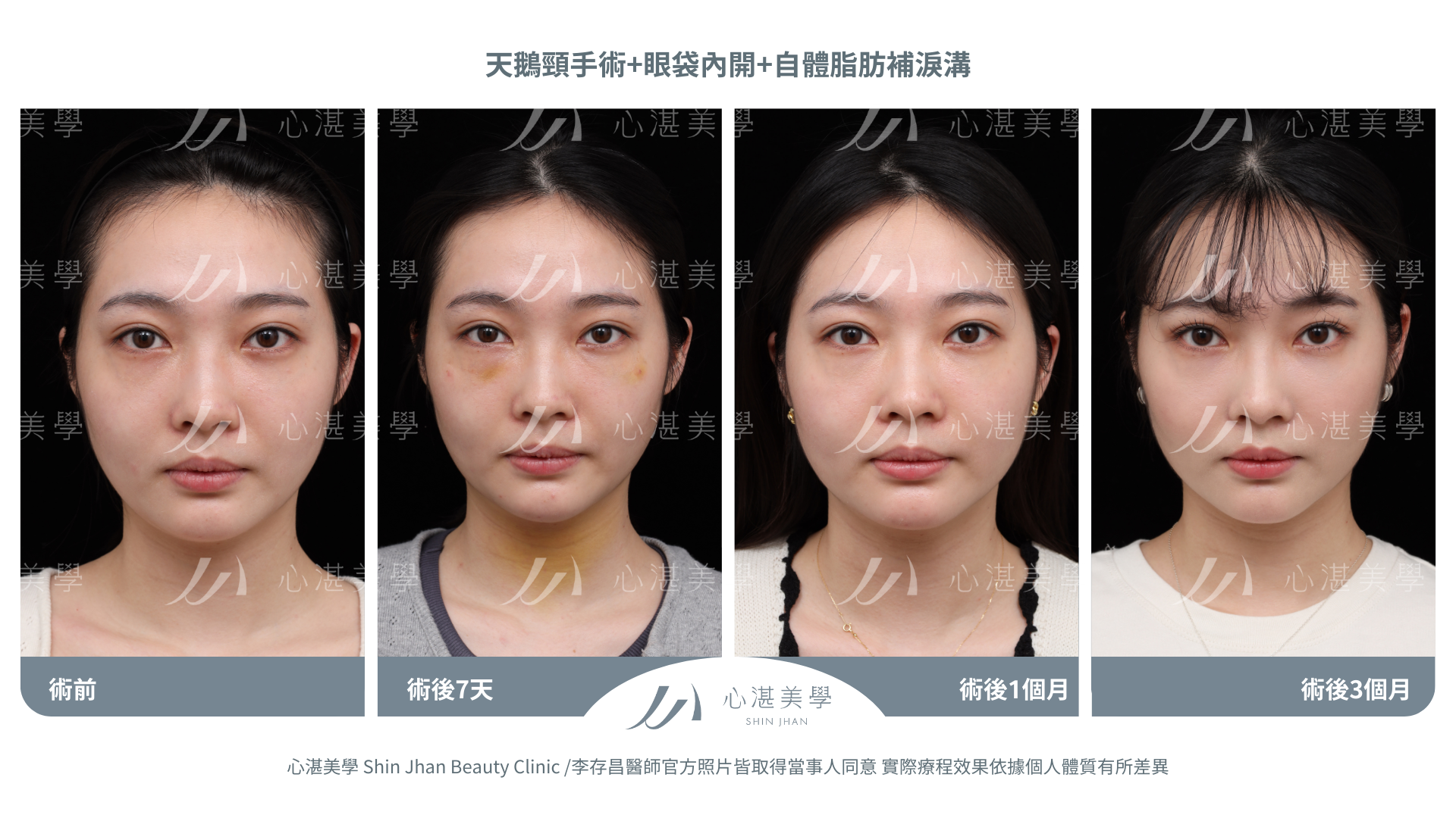 天鵝頸+眼袋內開+自體脂肪補淚溝案例分享 術前術後