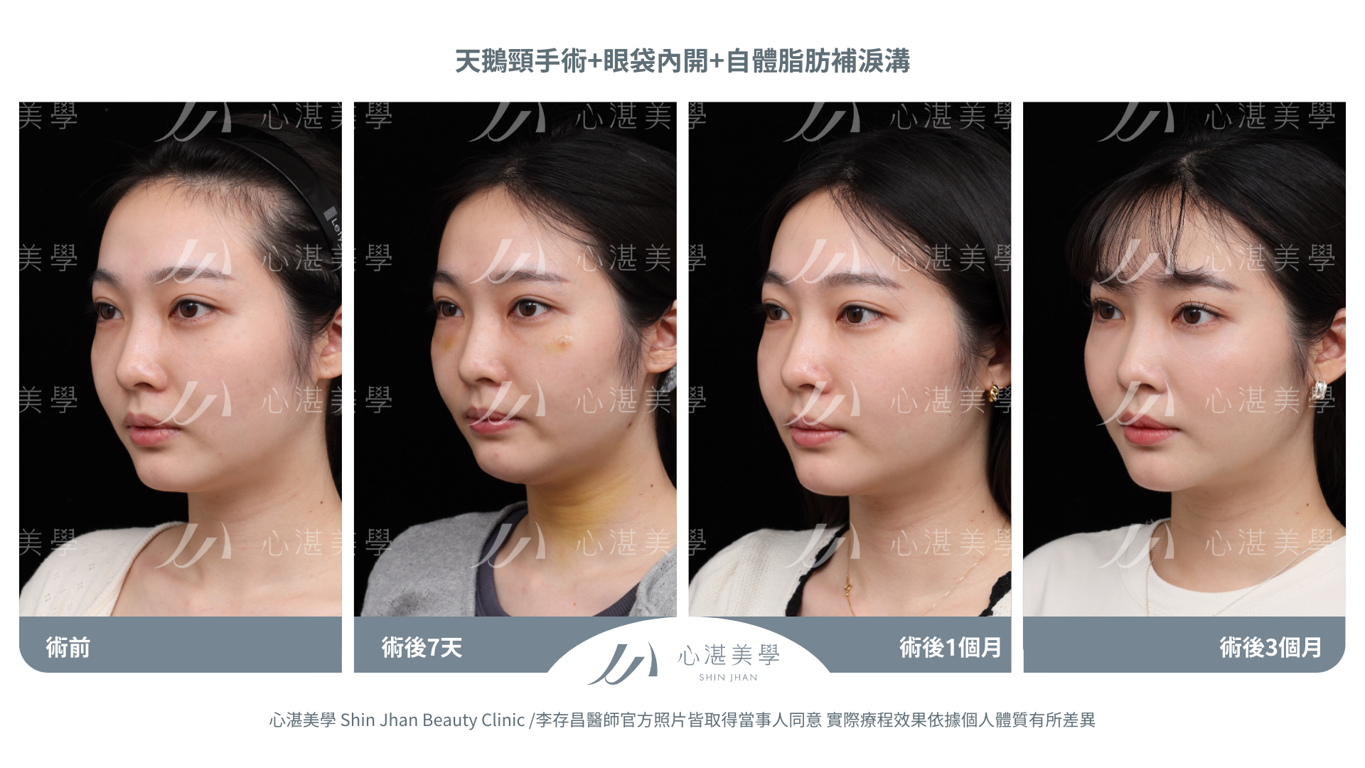 天鵝頸+眼袋內開+自體脂肪補淚溝案例分享 術前術後