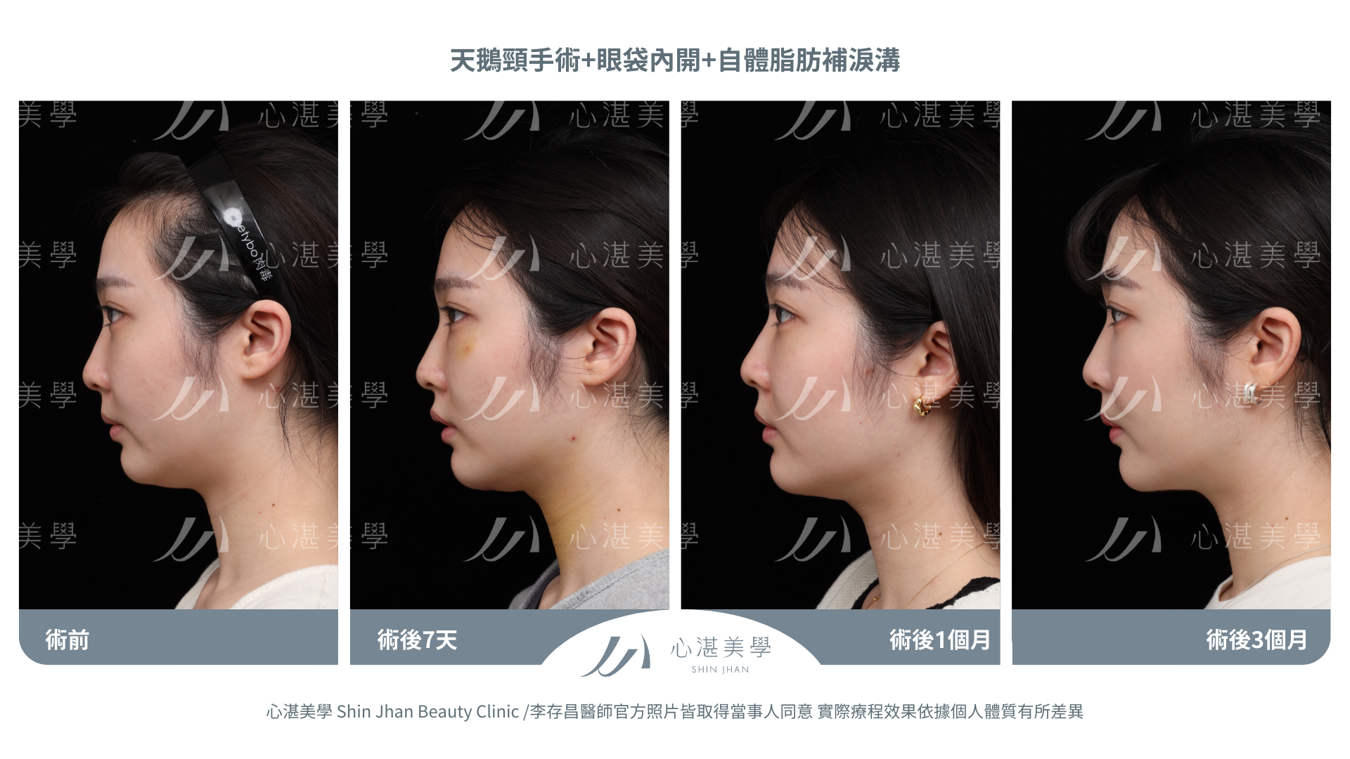 天鵝頸+眼袋內開+自體脂肪補淚溝案例分享 術前術後
