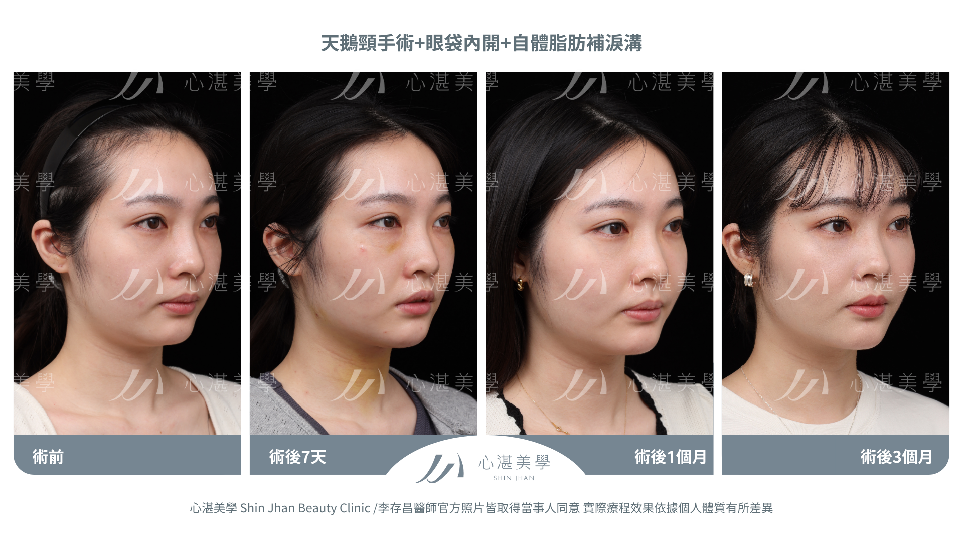 天鵝頸+眼袋內開+自體脂肪補淚溝案例分享 術前術後