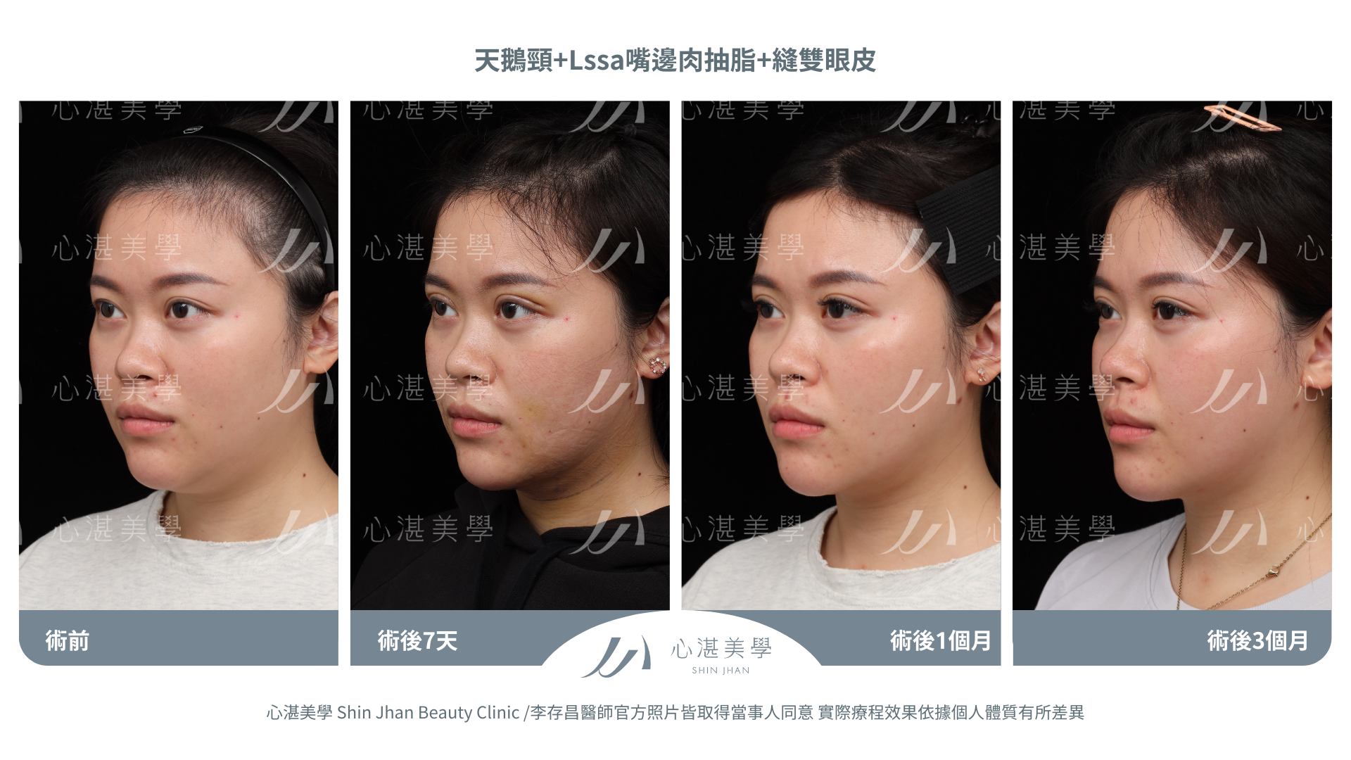 天鵝頸+LSSA嘴邊肉抽脂+縫雙眼皮案例分享 術前術後