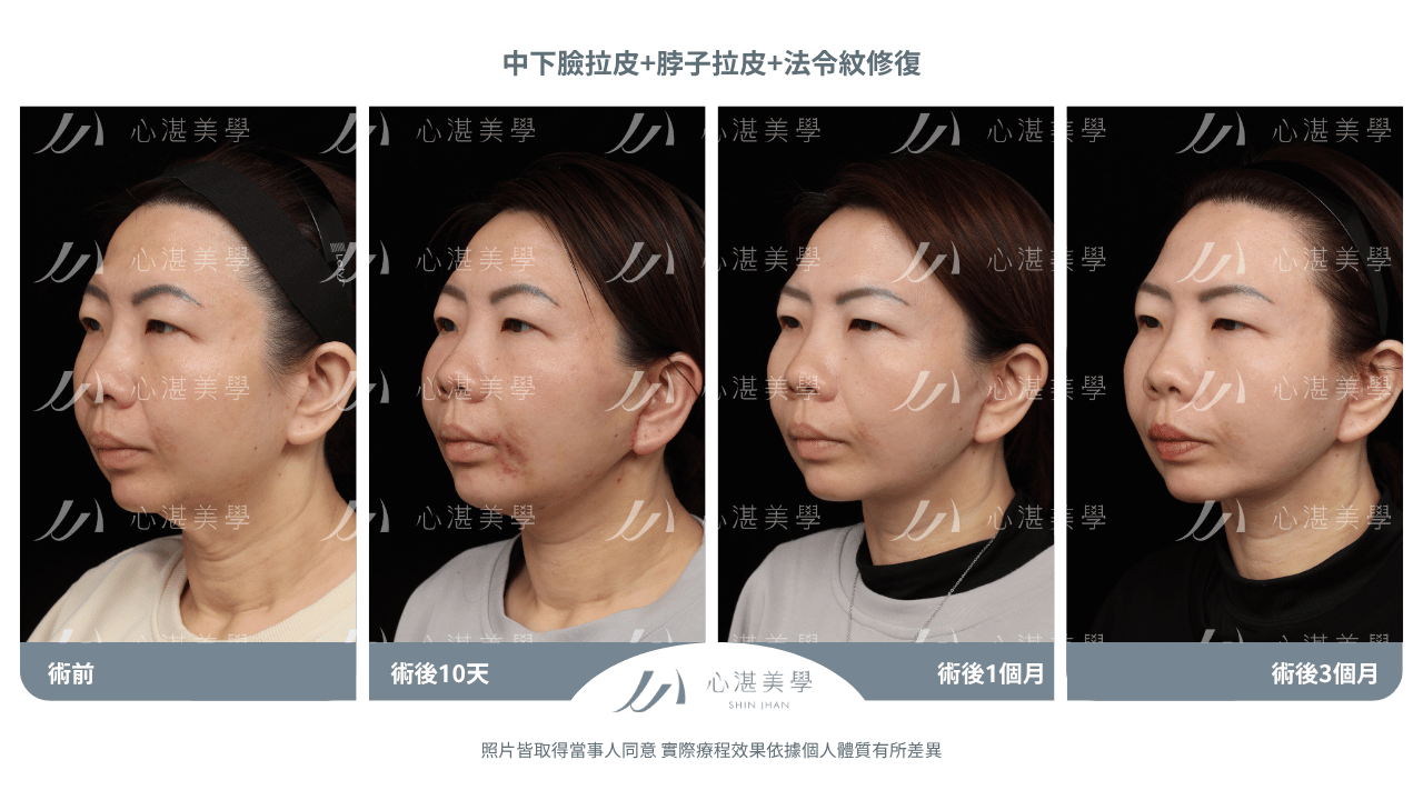 中下臉拉皮+法令紋修復案例分享 術前術後