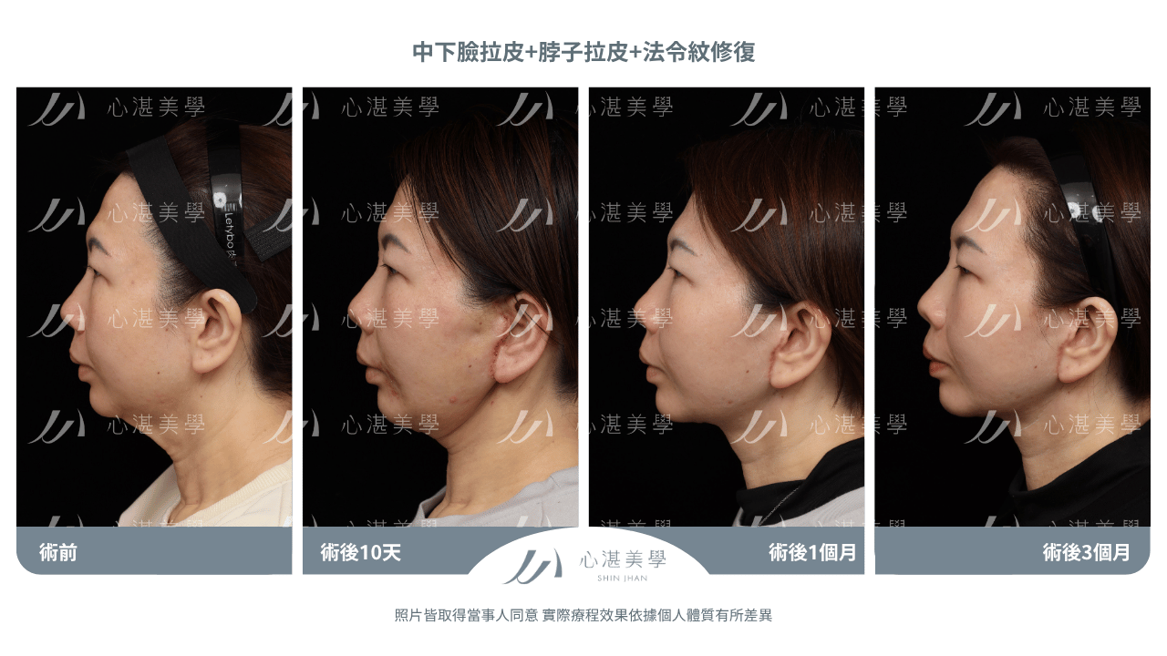 中下臉拉皮+法令紋修復案例分享 術前術後