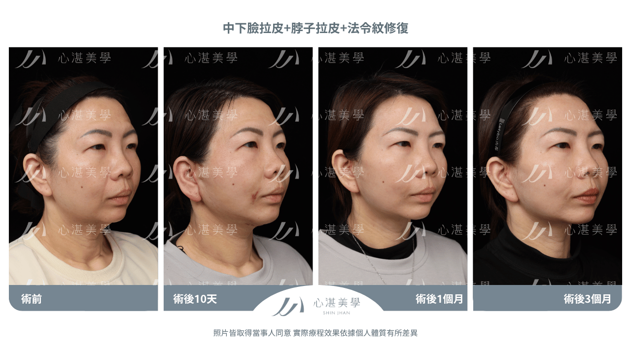 中下臉拉皮+法令紋修復案例分享 術前術後