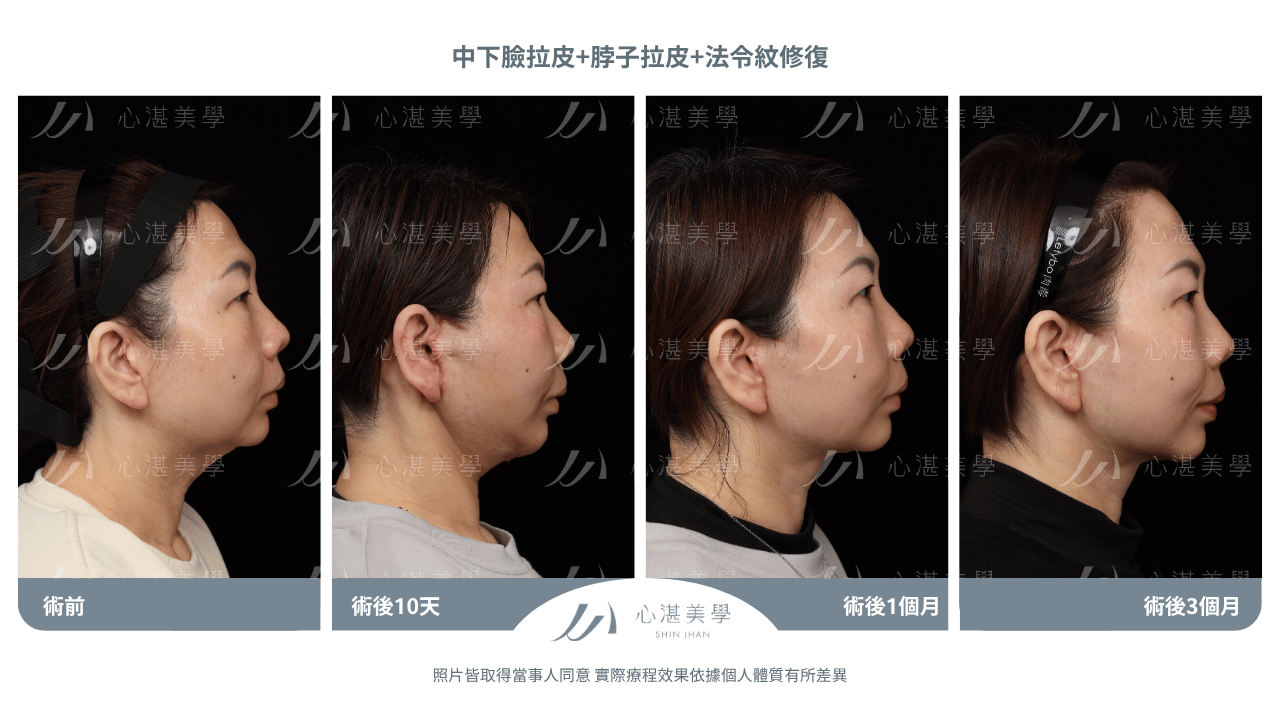 中下臉拉皮+法令紋修復案例分享 術前術後