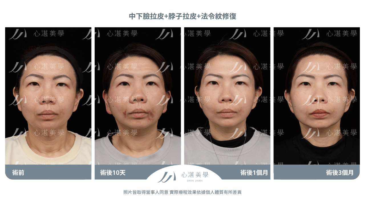 中下臉拉皮+法令紋修復案例分享 術前術後