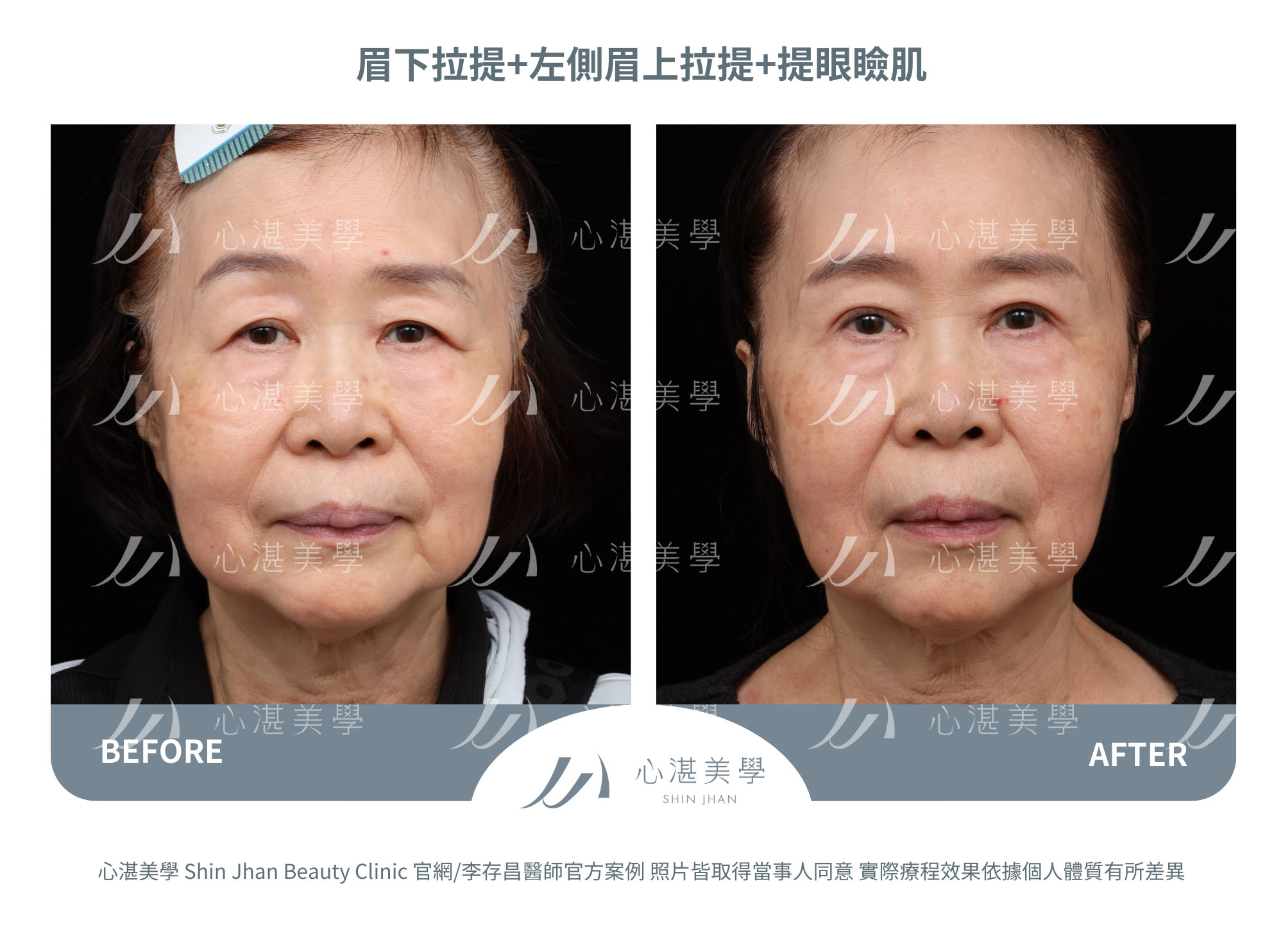 眉下切(提眉手術)+眉上切(提眉手術)+提眼瞼肌手術案例術前術後對比