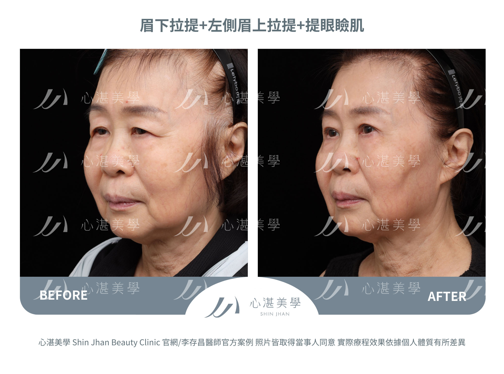 眉下切(提眉手術)+眉上切(提眉手術)+提眼瞼肌手術案例術前術後對比