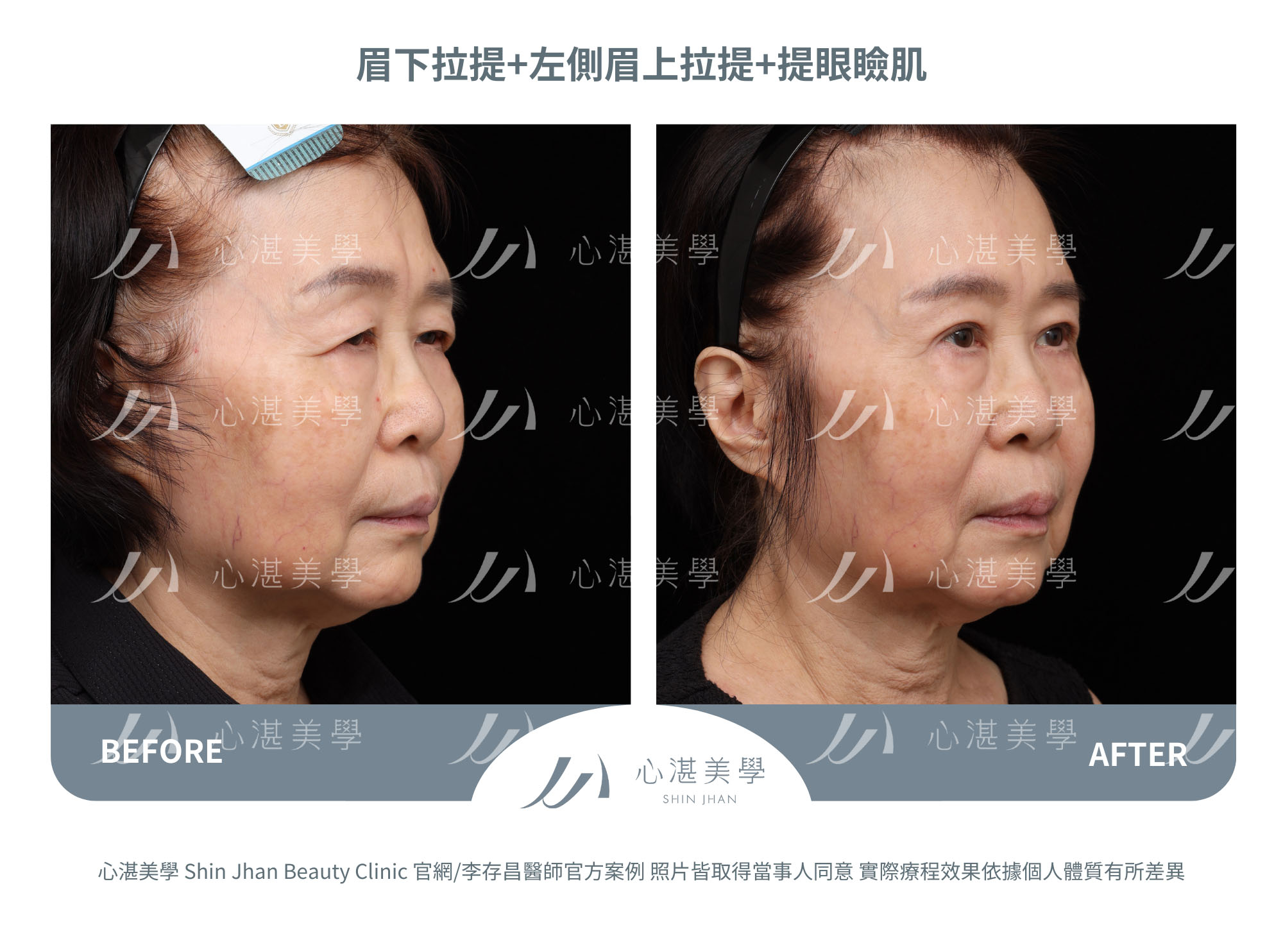 眉下切(提眉手術)+眉上切(提眉手術)+提眼瞼肌手術案例術前術後對比
