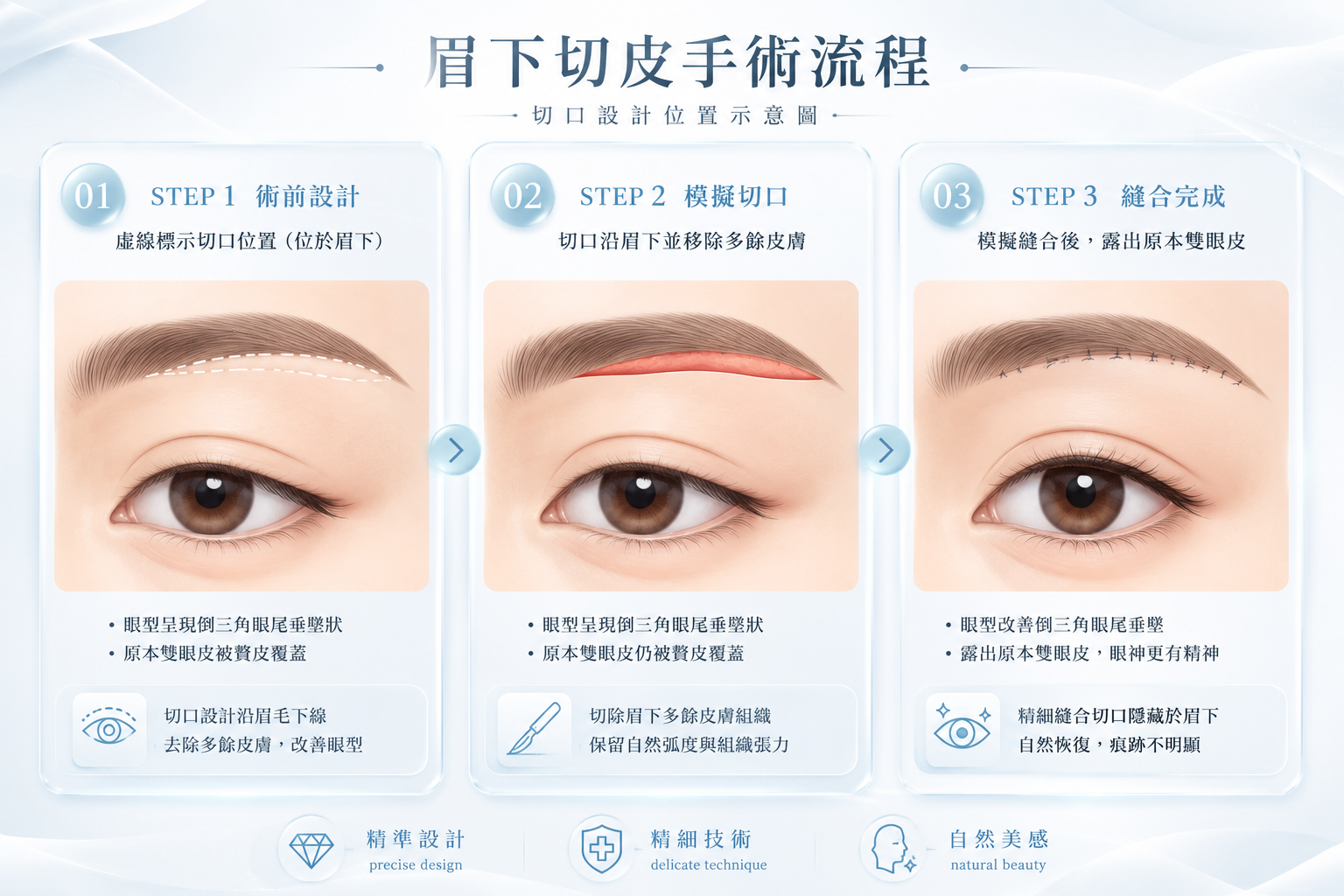 眉下切皮手術流程