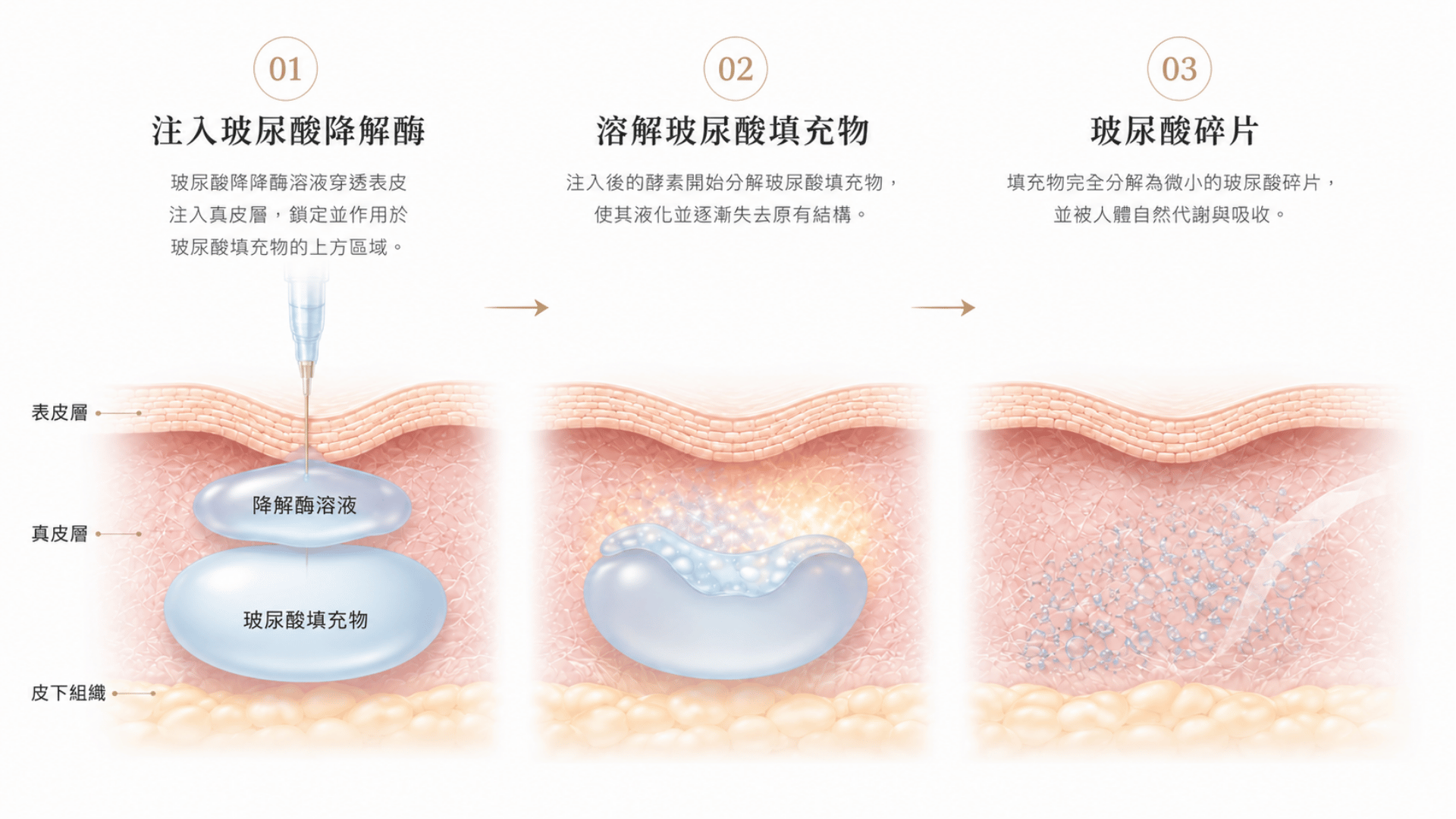 玻尿酸經降解酶溶解的三步驟醫學資訊圖,呈現降解酶注入、玻尿酸填充物分解,以及玻尿酸碎片逐步代謝的皮膚組織剖面。
