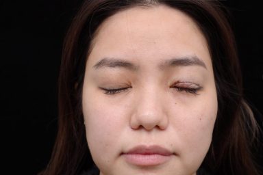 大小眼原來是因為眼窩凹陷！改善大小眼從此不再被說沒睡飽
