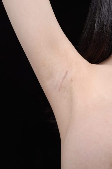 產後胸部萎縮的困擾，柔滴隆乳幫我解決下垂平胸問題